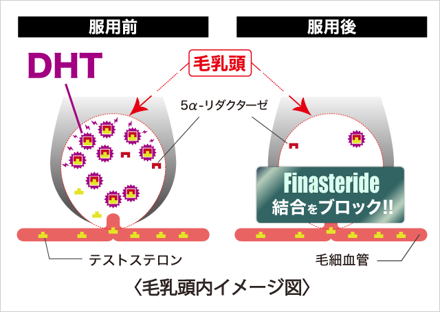 フィナステリド,BAS